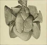 Picture 94 of 129 from The diseases of infancy and childhood : for the use of students and practitioners of medicine / by L. Emmett Holt and John Howland. (1911), leaf 887