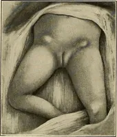 An illustration from The diseases of infancy and childhood : for the use of students and practitioners of medicine / by L. Emmett Holt and John Howland. (1911)
