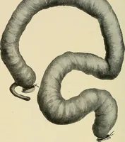 An illustration from The diseases of infancy and childhood : for the use of students and practitioners of medicine / by L. Emmett Holt and John Howland. (1911)