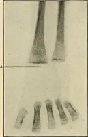 An illustration from The diseases of infancy and childhood : for the use of students and practitioners of medicine / by L. Emmett Holt and John Howland. (1911)