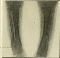 An illustration from The diseases of infancy and childhood : for the use of students and practitioners of medicine / by L. Emmett Holt and John Howland. (1911)