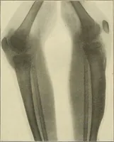 An illustration from The diseases of infancy and childhood : for the use of students and practitioners of medicine / by L. Emmett Holt and John Howland. (1911)