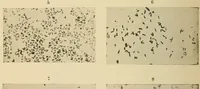 An illustration from The diseases of infancy and childhood : for the use of students and practitioners of medicine / by L. Emmett Holt with two hundred and forty-one illustrations, including eight coloured plates. (1908)