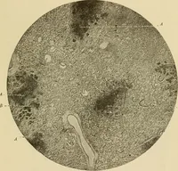 An illustration from The diseases of infancy and childhood : for the use of students and practitioners of medicine / by L. Emmett Holt with two hundred and forty-one illustrations, including eight coloured plates. (1908)
