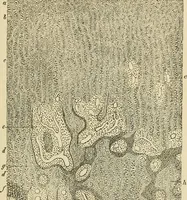 An illustration from The diseases of infancy and childhood : for the use of students and practitioners of medicine / by L. Emmett Holt with two hundred and forty-one illustrations, including eight coloured plates. (1908)