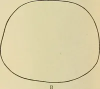 An illustration from The diseases of infancy and childhood : for the use of students and practitioners of medicine / by L. Emmett Holt with two hundred and forty-one illustrations, including eight coloured plates. (1908)