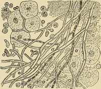 Picture 20 of 83 from The diseases of infancy and childhood : for the use of students and practitioners of medicine / by L. Emmett Holt with two hundred and forty-one illustrations, including eight coloured plates. (1908), leaf 319