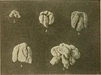 An illustration from The diseases of infancy and childhood : for the use of students and practitioners of medicine / by L. Emmett Holt with two hundred and forty-one illustrations, including eight coloured plates. (1908)