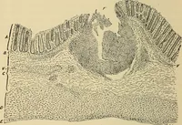 An illustration from The diseases of infancy and childhood : for the use of students and practitioners of medicine / by L. Emmett Holt with two hundred and forty-one illustrations, including eight coloured plates. (1908)