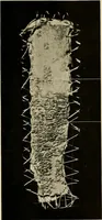 An illustration from The diseases of infancy and childhood : for the use of students and practitioners of medicine / by L. Emmett Holt with two hundred and forty-one illustrations, including eight coloured plates. (1908)