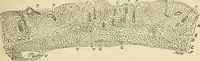 An illustration from The diseases of infancy and childhood : for the use of students and practitioners of medicine / by L. Emmett Holt with two hundred and forty-one illustrations, including eight coloured plates. (1908)