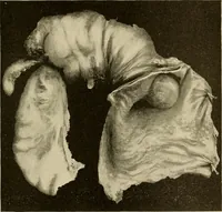 Picture 37 of 83 from The diseases of infancy and childhood : for the use of students and practitioners of medicine / by L. Emmett Holt with two hundred and forty-one illustrations, including eight coloured plates. (1908), leaf 467