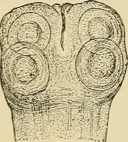 An illustration from The diseases of infancy and childhood : for the use of students and practitioners of medicine / by L. Emmett Holt with two hundred and forty-one illustrations, including eight coloured plates. (1908)
