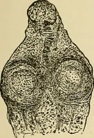 An illustration from The diseases of infancy and childhood : for the use of students and practitioners of medicine / by L. Emmett Holt with two hundred and forty-one illustrations, including eight coloured plates. (1908)
