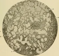 An illustration from The diseases of infancy and childhood : for the use of students and practitioners of medicine / by L. Emmett Holt with two hundred and forty-one illustrations, including eight coloured plates. (1908)