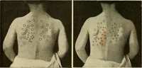 An illustration from The diseases of infancy and childhood : for the use of students and practitioners of medicine / by L. Emmett Holt with two hundred and forty-one illustrations, including eight coloured plates. (1908)