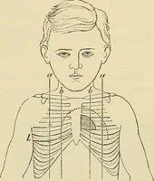 An illustration from The diseases of infancy and childhood : for the use of students and practitioners of medicine / by L. Emmett Holt with two hundred and forty-one illustrations, including eight coloured plates. (1908)