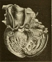 An illustration from The diseases of infancy and childhood : for the use of students and practitioners of medicine / by L. Emmett Holt with two hundred and forty-one illustrations, including eight coloured plates. (1908)