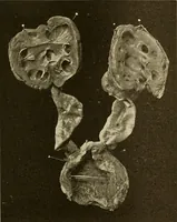 An illustration from The diseases of infancy and childhood : for the use of students and practitioners of medicine / by L. Emmett Holt with two hundred and forty-one illustrations, including eight coloured plates. (1908)