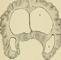 Picture 56 of 83 from The diseases of infancy and childhood : for the use of students and practitioners of medicine / by L. Emmett Holt with two hundred and forty-one illustrations, including eight coloured plates. (1908), leaf 835