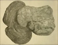 An illustration from The diseases of infancy and childhood : for the use of students and practitioners of medicine / by L. Emmett Holt with two hundred and forty-one illustrations, including eight coloured plates. (1908)