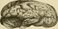 An illustration from The diseases of infancy and childhood : for the use of students and practitioners of medicine / by L. Emmett Holt with two hundred and forty-one illustrations, including eight coloured plates. (1908)