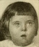 An illustration from The diseases of infancy and childhood : for the use of students and practitioners of medicine / by L. Emmett Holt with two hundred and forty-one illustrations, including eight coloured plates. (1908)
