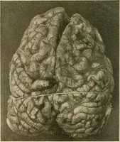 An illustration from The diseases of infancy and childhood : for the use of students and practitioners of medicine / by L. Emmett Holt with two hundred and forty-one illustrations, including eight coloured plates. (1908)