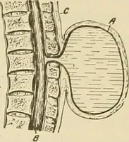 An illustration from The diseases of infancy and childhood : for the use of students and practitioners of medicine / by L. Emmett Holt with two hundred and forty-one illustrations, including eight coloured plates. (1908)