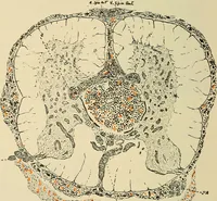 An illustration from The diseases of infancy and childhood : for the use of students and practitioners of medicine / by L. Emmett Holt with two hundred and forty-one illustrations, including eight coloured plates. (1908)