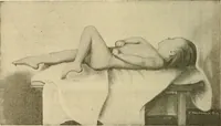 An illustration from The diseases of infancy and childhood : for the use of students and practitioners of medicine / by L. Emmett Holt with two hundred and forty-one illustrations, including eight coloured plates. (1908)
