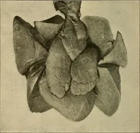 An illustration from The diseases of infancy and childhood : for the use of students and practitioners of medicine / by L. Emmett Holt with two hundred and forty-one illustrations, including eight coloured plates. (1908)
