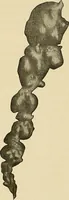 An illustration from The diseases of infancy and childhood : for the use of students and practitioners of medicine / by L. Emmett Holt with two hundred and forty-one illustrations, including eight coloured plates. (1908)