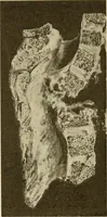 An illustration from The diseases of infancy and childhood : for the use of students and practitioners of medicine / by L. Emmett Holt with two hundred and forty-one illustrations, including eight coloured plates. (1908)