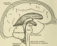 Picture 5 of 23 from Meningococcus meningitis / by Henry Heiman ... and Samuel Feldstein ... with introduction by Henry Koplik ... with 4 plates, 31 figures, 2 in color, and 4 charts. (1913), leaf 106
