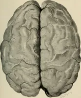 An illustration from Meningococcus meningitis / by Henry Heiman ... and Samuel Feldstein ... with introduction by Henry Koplik ... with 4 plates, 31 figures, 2 in color, and 4 charts. (1913)