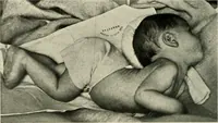 An illustration from Meningococcus meningitis / by Henry Heiman ... and Samuel Feldstein ... with introduction by Henry Koplik ... with 4 plates, 31 figures, 2 in color, and 4 charts. (1913)