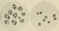 An illustration from Meningococcus meningitis / by Henry Heiman ... and Samuel Feldstein ... with introduction by Henry Koplik ... with 4 plates, 31 figures, 2 in color, and 4 charts. (1913)