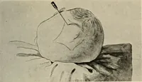 An illustration from Meningococcus meningitis / by Henry Heiman ... and Samuel Feldstein ... with introduction by Henry Koplik ... with 4 plates, 31 figures, 2 in color, and 4 charts. (1913)