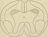 An illustration from Practical diagnosis: the use of symptoms in the diagnosis of disease / By Hobart Amory Hare ... Illustrated with 191 engravings and 13 colored plates. (1896)