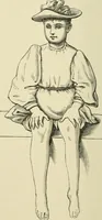 An illustration from Practical diagnosis: the use of symptoms in the diagnosis of disease / By Hobart Amory Hare ... Illustrated with 191 engravings and 13 colored plates. (1896)