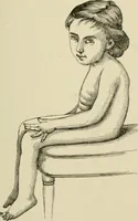 An illustration from Practical diagnosis: the use of symptoms in the diagnosis of disease / By Hobart Amory Hare ... Illustrated with 191 engravings and 13 colored plates. (1896)