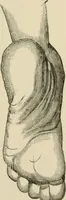 An illustration from Practical diagnosis: the use of symptoms in the diagnosis of disease / By Hobart Amory Hare ... Illustrated with 191 engravings and 13 colored plates. (1896)