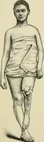 An illustration from Practical diagnosis: the use of symptoms in the diagnosis of disease / By Hobart Amory Hare ... Illustrated with 191 engravings and 13 colored plates. (1896)
