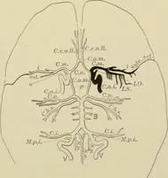 An illustration from Practical diagnosis: the use of symptoms in the diagnosis of disease / By Hobart Amory Hare ... Illustrated with 191 engravings and 13 colored plates. (1896)