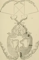 An illustration from Practical diagnosis: the use of symptoms in the diagnosis of disease / By Hobart Amory Hare ... Illustrated with 191 engravings and 13 colored plates. (1896)