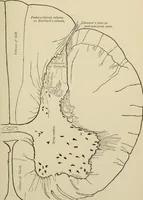 An illustration from Practical diagnosis: the use of symptoms in the diagnosis of disease / By Hobart Amory Hare ... Illustrated with 191 engravings and 13 colored plates. (1896)