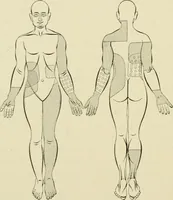 An illustration from Practical diagnosis: the use of symptoms in the diagnosis of disease / By Hobart Amory Hare ... Illustrated with 191 engravings and 13 colored plates. (1896)