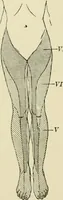 An illustration from Practical diagnosis: the use of symptoms in the diagnosis of disease / By Hobart Amory Hare ... Illustrated with 191 engravings and 13 colored plates. (1896)