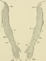 An illustration from Practical diagnosis: the use of symptoms in the diagnosis of disease / By Hobart Amory Hare ... Illustrated with 191 engravings and 13 colored plates. (1896)